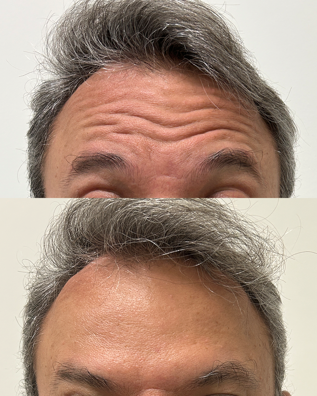 Harmonização facial com resultado natural