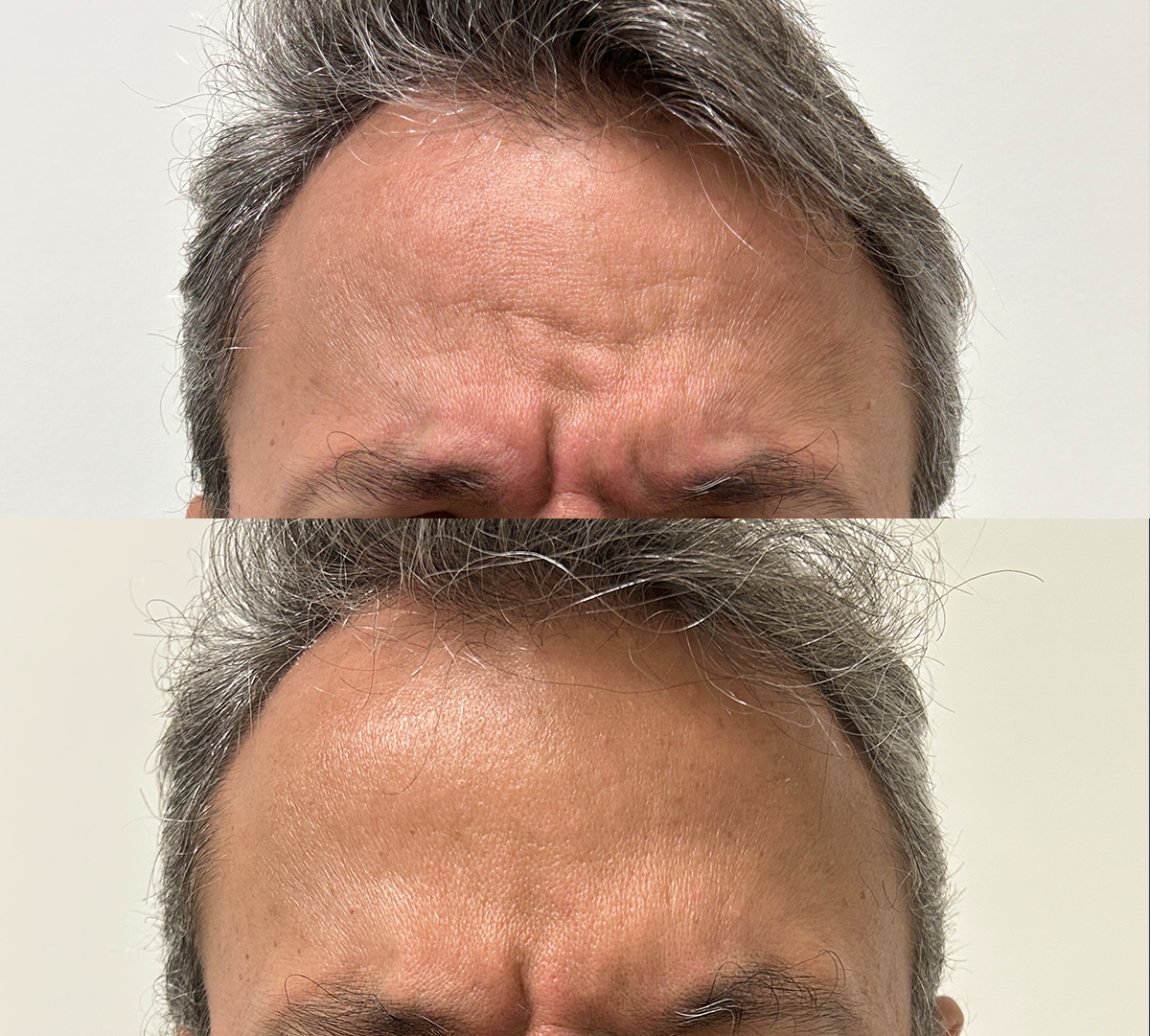 Antes e depois de harmonização facial